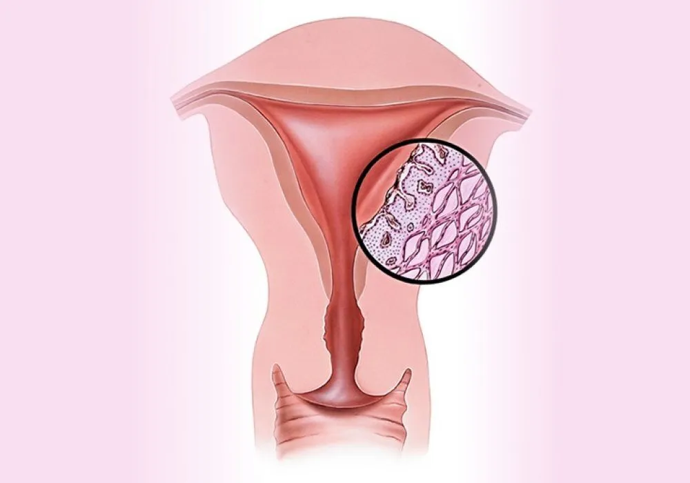 Dysmenorrhea