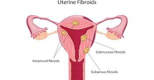 Uterine Fibroids